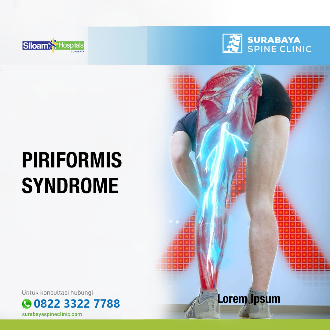 Piriformis Syndrome : Sebab, Gejala dan Penanganan